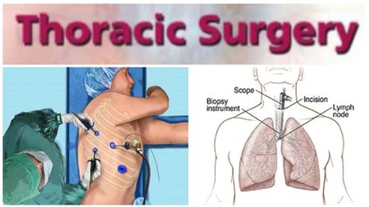 Discoveries And Insights In Thoracic Surgery